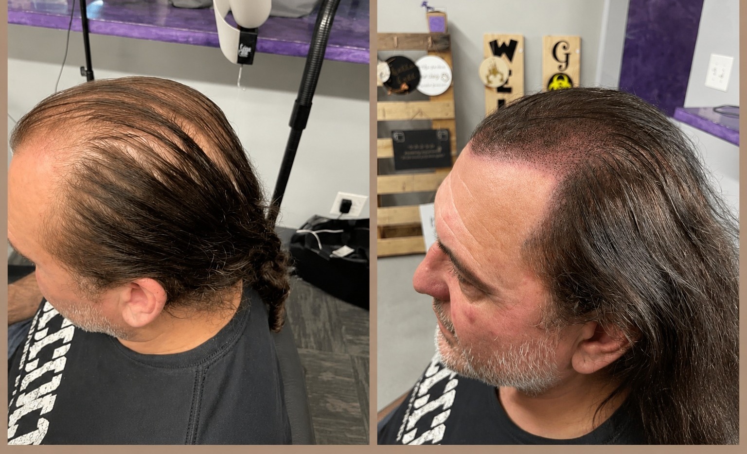 Crown and Top Hair Density Before and After